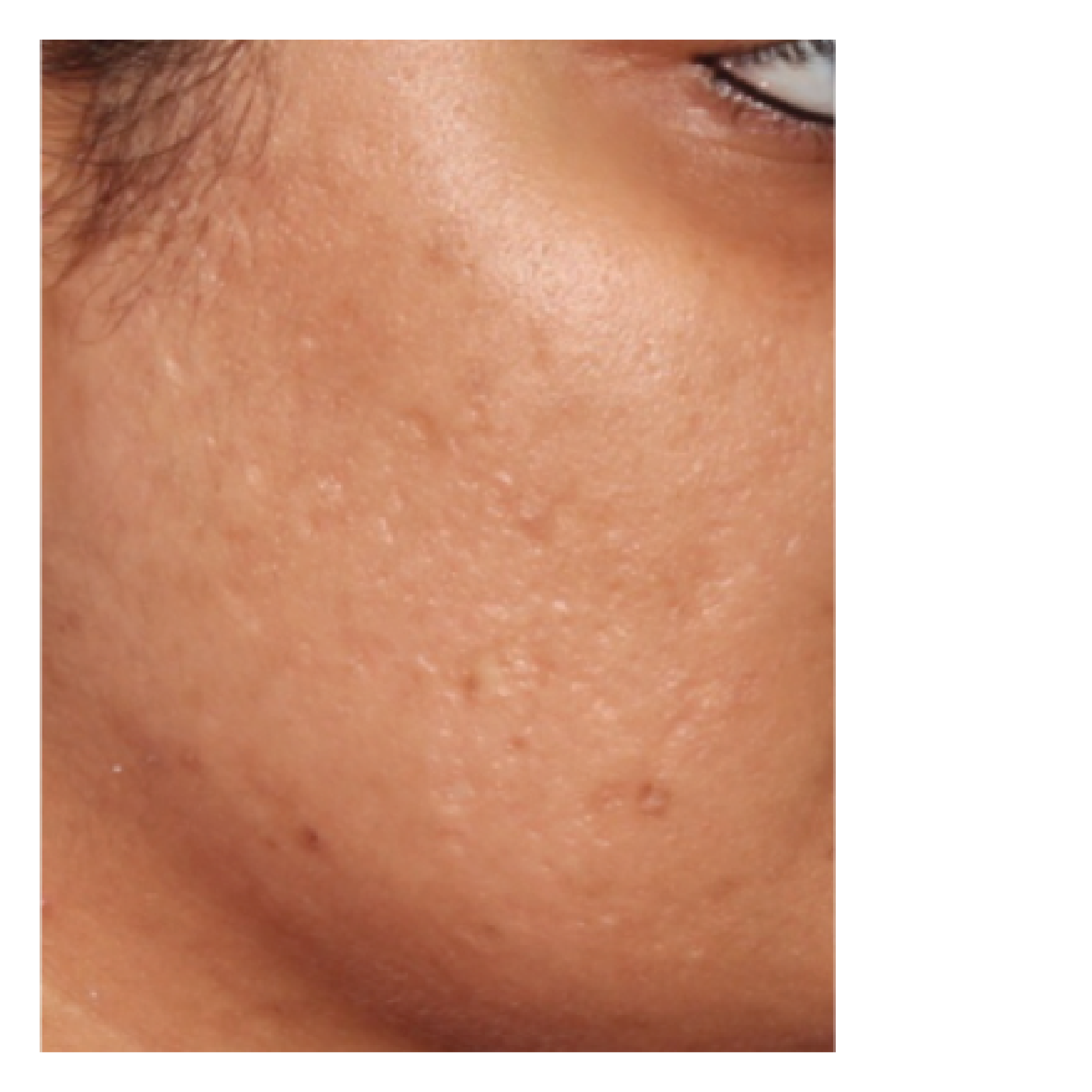 LPSMicroneedling5