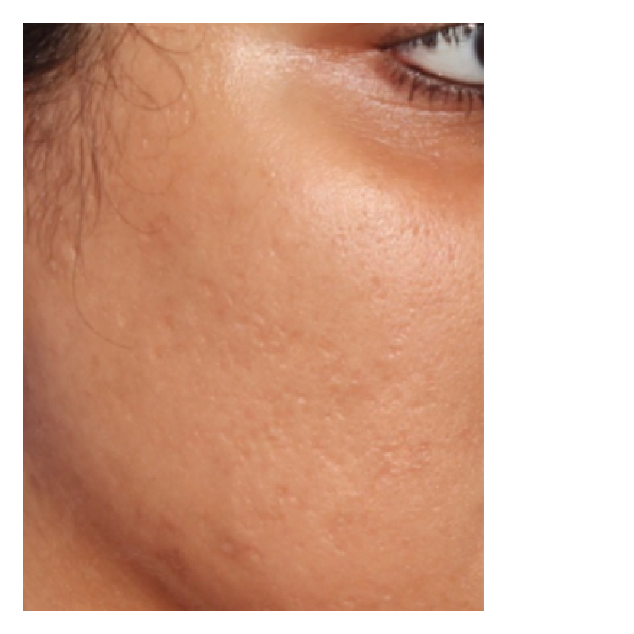 LPSMicroneedling6